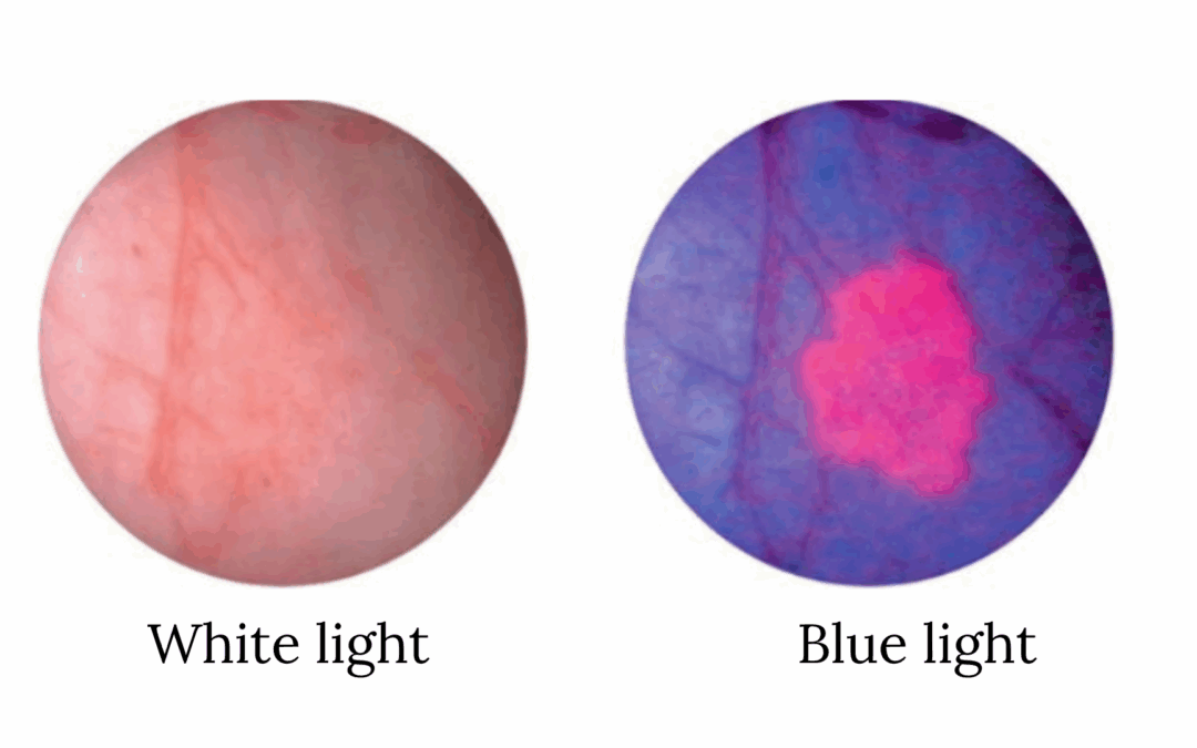 PSJMC acquires next-level technology to treat bladder cancer